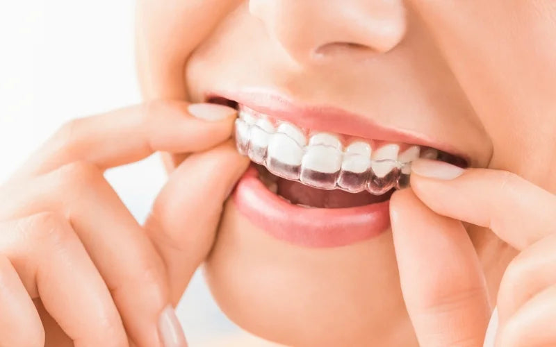 woman applying clear aligners for buck teeth