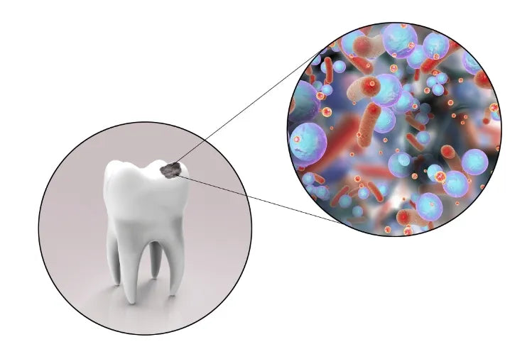An illustration of a tooth with a cavity and a detailed close‑up view of bacteria