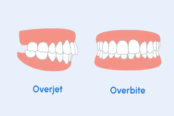 An image showing an Overbite vs Overjet.