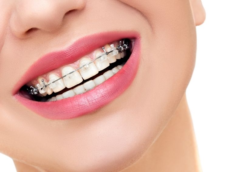 Orthodontics Australia  Average cost of ceramic braces in Australia