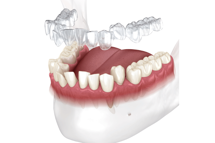 Clear aligners for malocclusions
