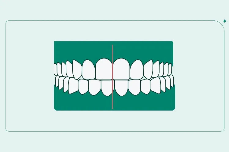 An illustration of a midline misalignment in incisors