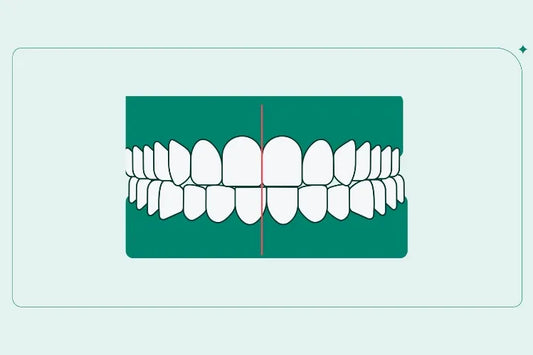 An illustration of a midline misalignment in incisors