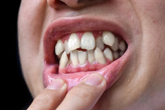 Fixing Overcrowded Teeth in Adults