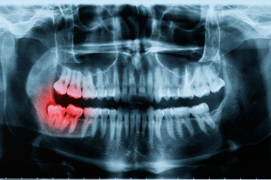 Clear Aligners for Treating Teeth Protrusion