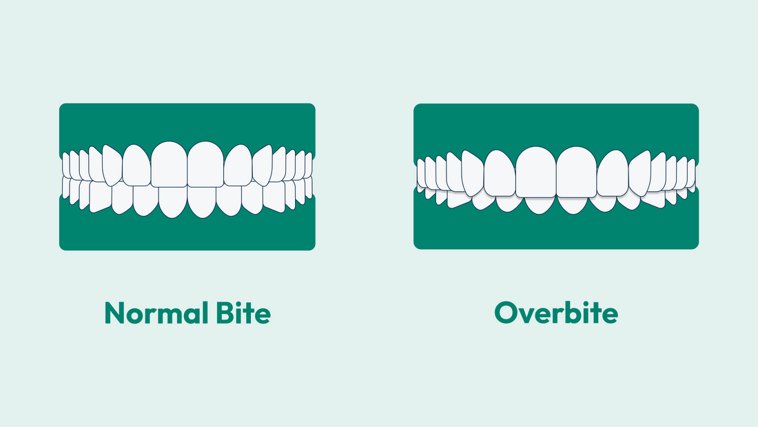 Class 1 (normal bite) vs Class 2 bite (overbite)