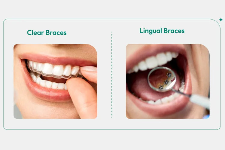 An image showing lingual braces and clear aligners