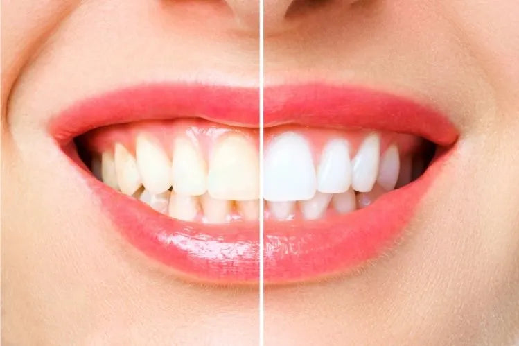 An image shows result of teeth whitening by two different whitening techniques