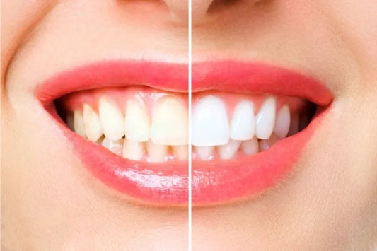 An image shows result of teeth whitening by two different whitening techniques