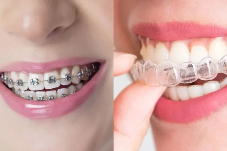 An image distinguish between clear braces vs metal braces