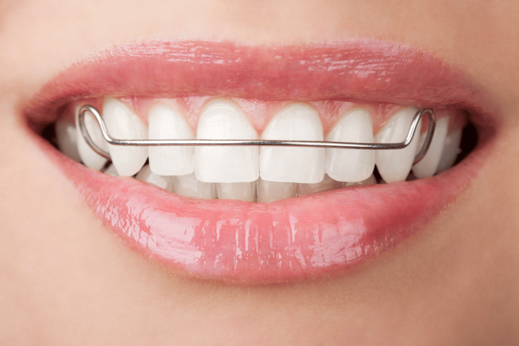 How Do Braces Move Teeth in The Right Position