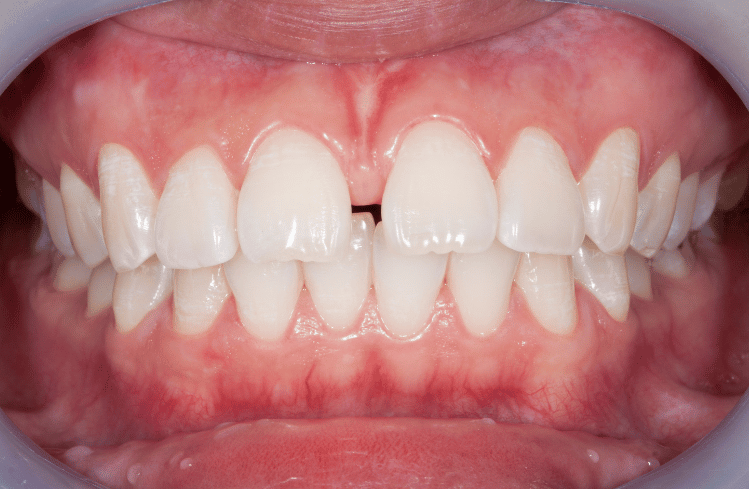 Invisible Aligners for Teeth