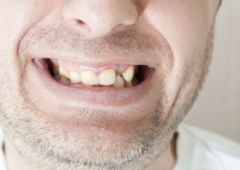 5-Signs-You’re-Suffering-From-Severe-Gum-Disease