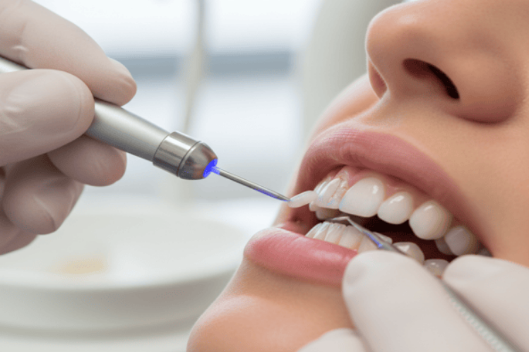 A dentist bonding a chipped and cracked tooth