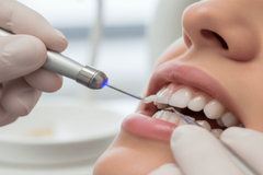 Teeth Bonding as a Quick Fix for Chipped Teeth