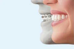 Aligners vs. Braces: Making The Right Decision