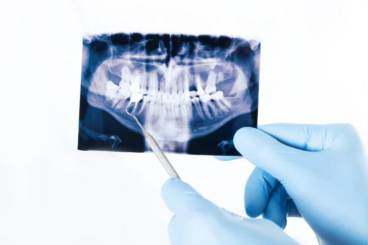 A person holding an x-ray of crowded teeth.