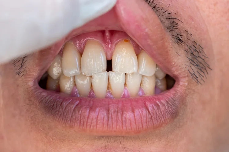 A person with huge gap in front teeth (incisors)