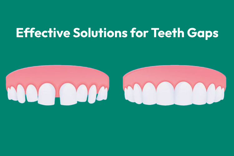 A side-by-side comparison of gapped teeth and normal teeth