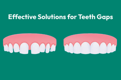 Worried about Spacing in Teeth? We Have Answers!