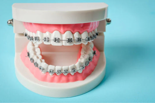 Are Dental Braces Worth the Investment?