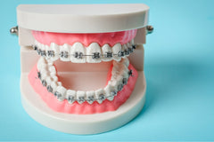 Are Dental Braces Worth the Investment? Discover How Much You'll Need to Spend