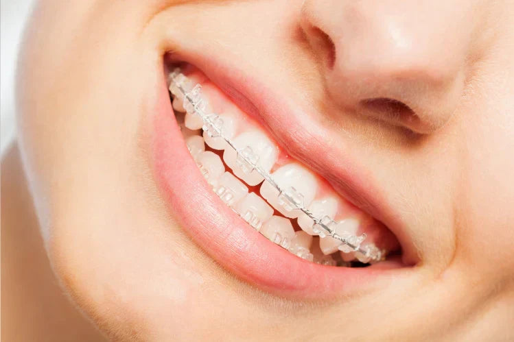 Dental Braces