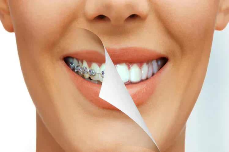 A close-up of a woman’s teeth with aligners on one side and braces on the other.