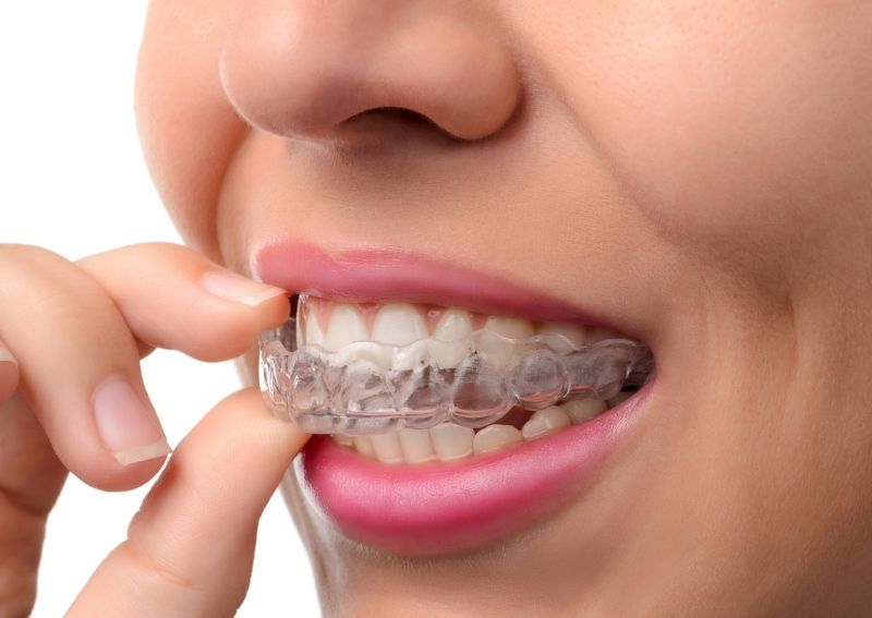 Are-Clear-Braces-Cheaper-Than-Metal-Braces