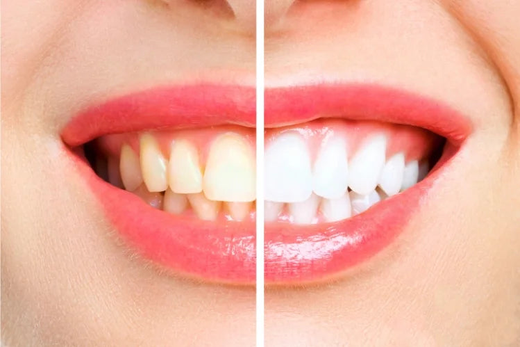 Woman's teeth show before & after of teeth whitening