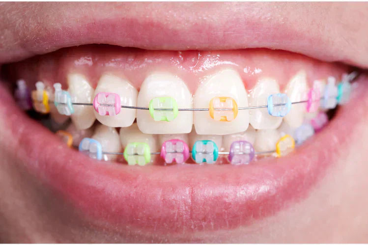 A person showing their coloured braces