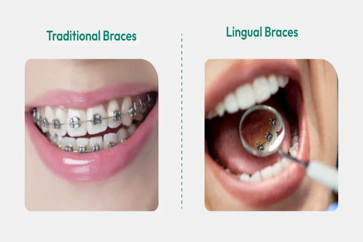 An illustration shows the distinction between metal and lingual braces