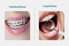 Metal vs Lingual Braces: Pros, Cons & Comfort