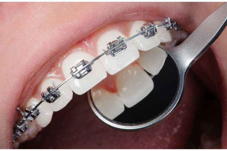 A close-up of a person's mouth with braces