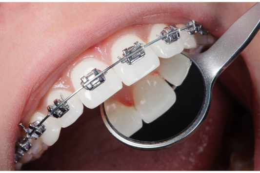 A close-up of a person's mouth with braces