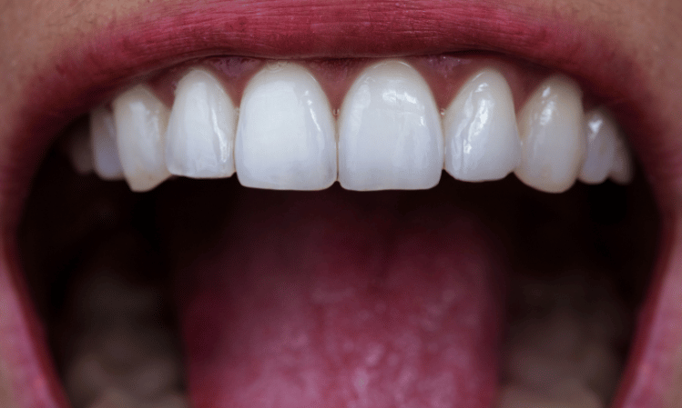 Braces vs Aligners