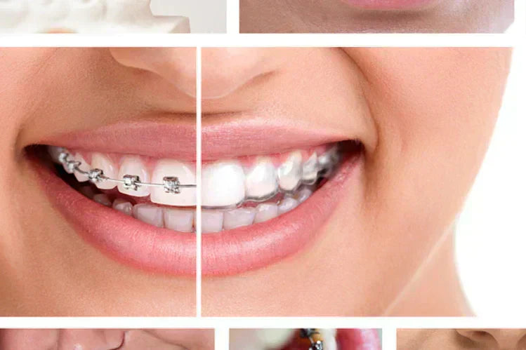 Aligners vs braces: what is the difference between both
