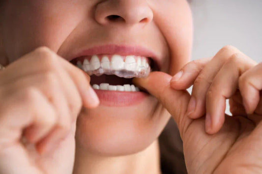 A girl applying teeth aligners. 