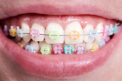 Braces Colors Guide: Popular Choices for Every Age