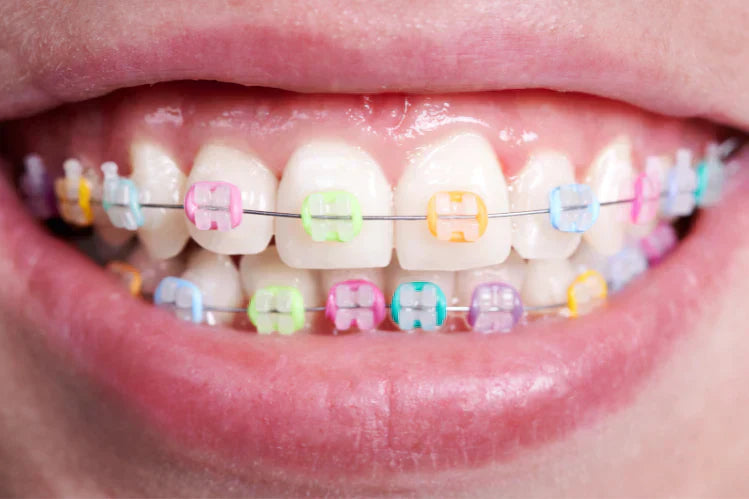 An image of teeth with colorful braces 