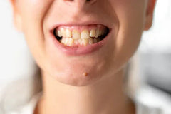 Crooked Teeth: Causes, Effects & Treatment Options