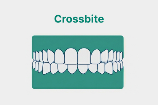 An illustration showing a crossbite. 