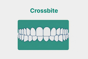 What Is a Crossbite and Its Treatment Options