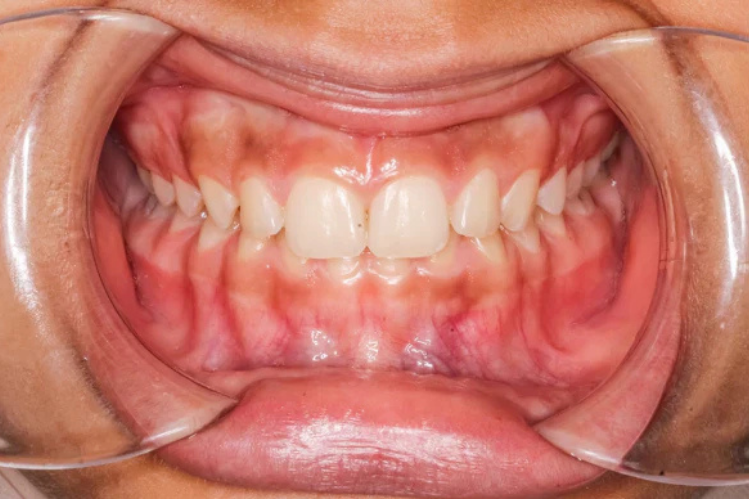Deep bite teeth
