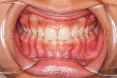 Deep Bite: More than a Cosmetic Issue