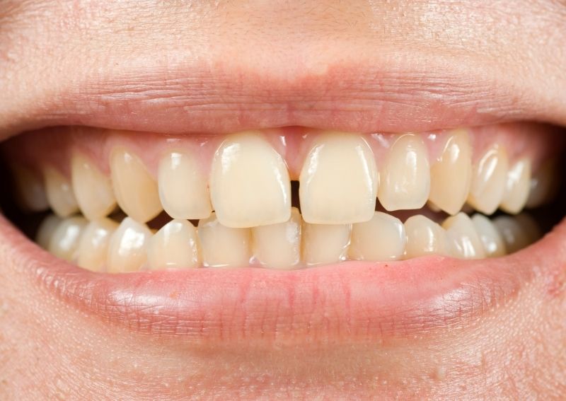 Fix-the-Gap-in-Between-Teeth-Without-Braces-Heres-How