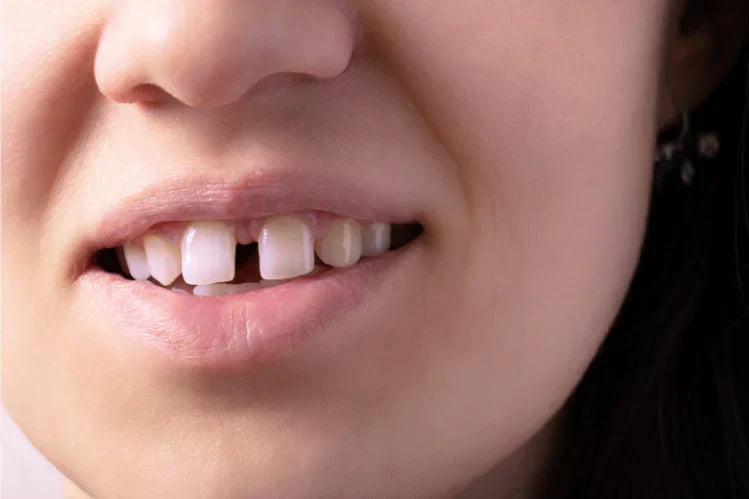A close-up of a woman showing a gap between her anterior front teeth 