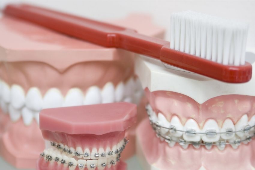 How-Do-Fixed-Dental-Braces-Straighten-Teeth?