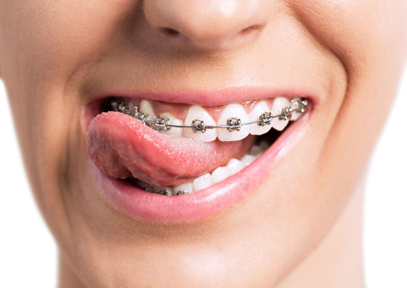 How-Much-Are-Braces-in-Australia-in-2022