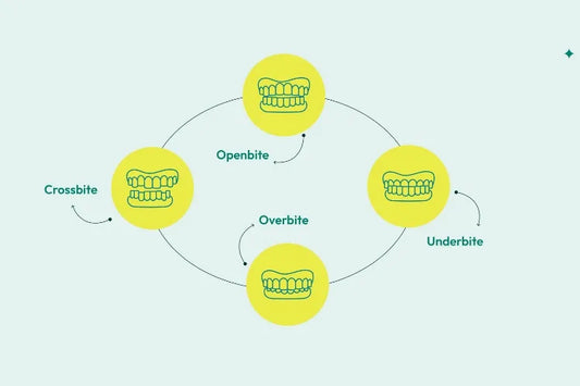Illustration showing different types of dental bite issues: open bite, underbite, overbite, and crossbite